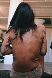 Žena s kožní nemocí EDS (foto + video)
