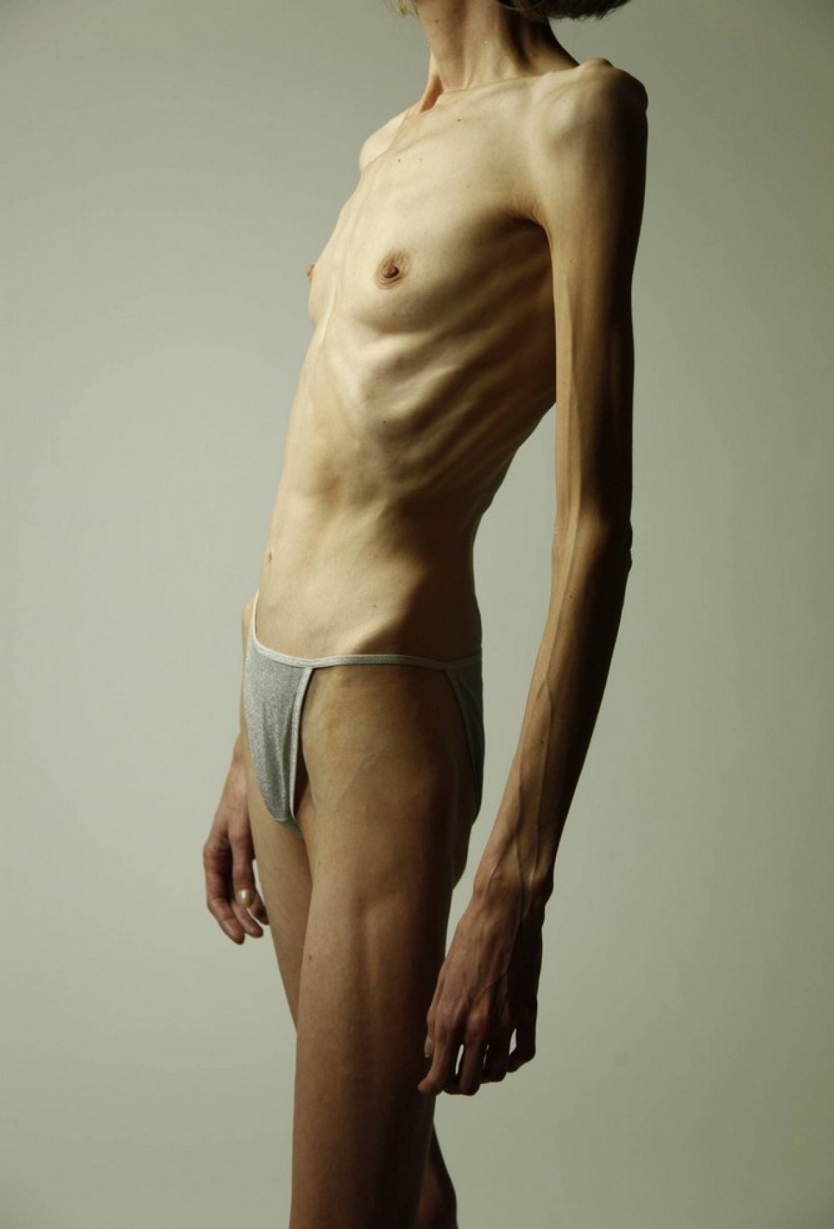 Anorexia girls nackt