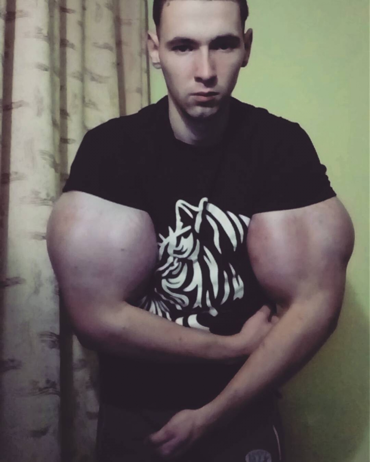 Synthol Man Dies